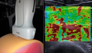 Entwicklung und biomechanische Charakterisierung realistischer Gewebephantome für die Elastographie bei Endometriose